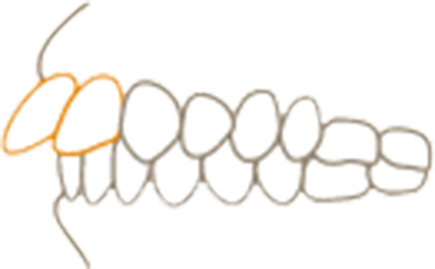 出っ歯（上顎前突）