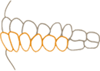 受け口（下顎前突）