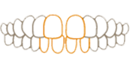 すきっ歯（空隙歯列）