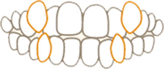 デコボコの歯（叢生・八重歯）