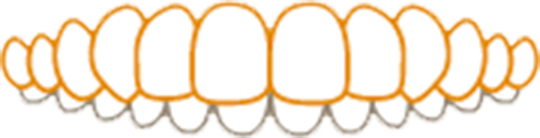 歯が重なる（過蓋咬合）