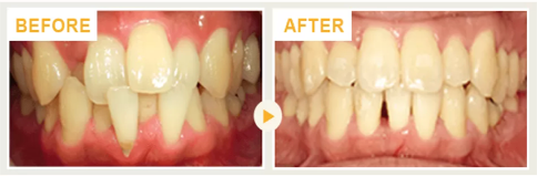 前歯部が前後バラバラに噛んでいる叢生の矯正治療症例
